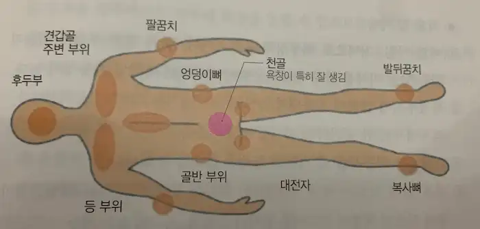 똑바로 누워 지내는 환자의 욕창 호발 부위 (뒷모습)
