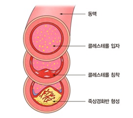 심근경색