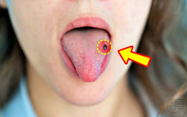 피부병 혀에 혹 붓기 입술염증 엽산결핍 혀암 설암