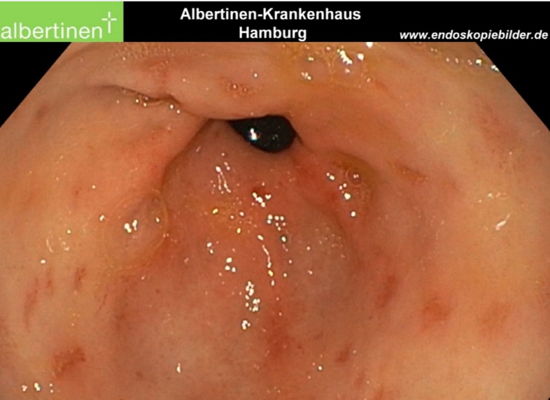 내시경을 통해 본 미란성 위염