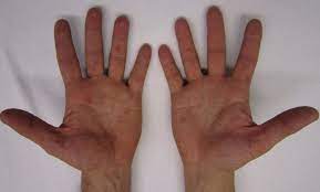 수족구병 증상 및 예방 조치