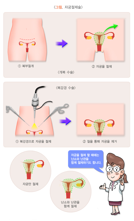 자궁근종