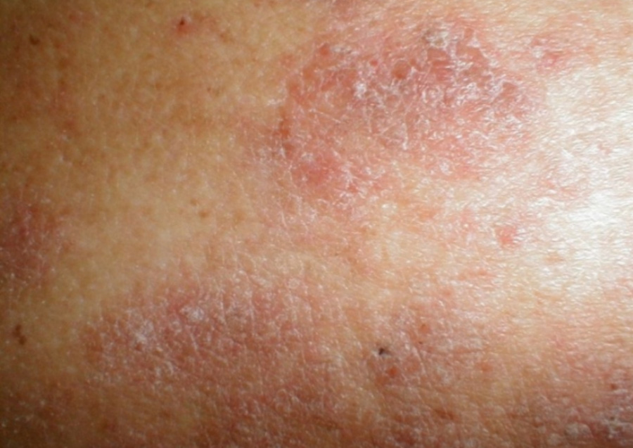 피부가 가렵고 건조해져서 자구 긁어서 피가 맺히고 검어지면서 두툼해진 태선화 피부를 확대를 하여 찍은 사진