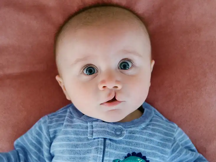 산모를 위한 구순구개열 정보 총정리