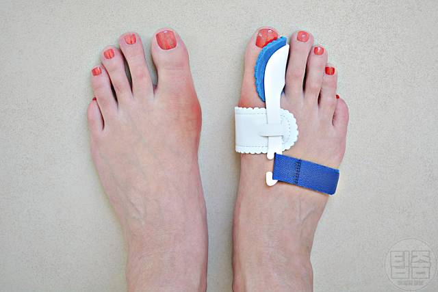 엄지발가락 옆 통증 건막류 치료 엄지발가락 휘어짐 교정기