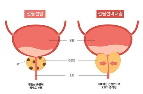 전립선 영양제