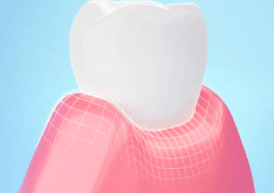 잇몸 염증 치료약