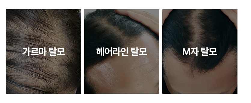 3가지-유형의-탈모를-보여주고-있습니다.