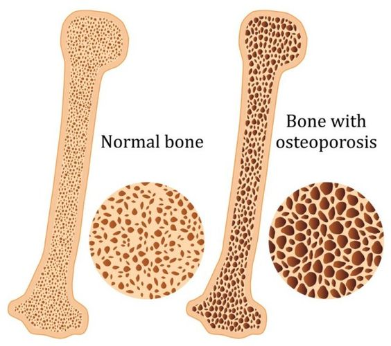 칼슘 부족, 뼈 건강을 위한 길잡이