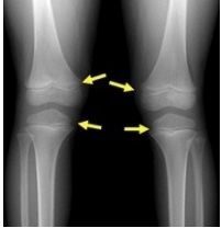 성장판 닫혀도 키크는법