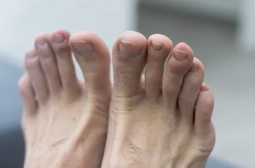 발톱 무좀 증상