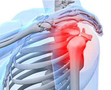 어깨 통증 원인