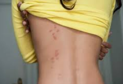 빈대 물린자국으로 인한 정신적 스트레스