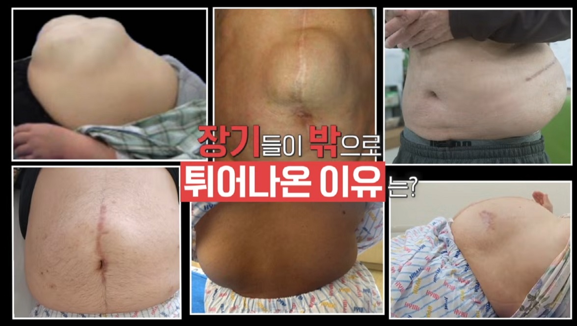 탈장-하태경-교수