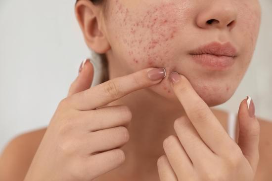 여드름(Acne) – 원인, 유형, 치료 방법 정리