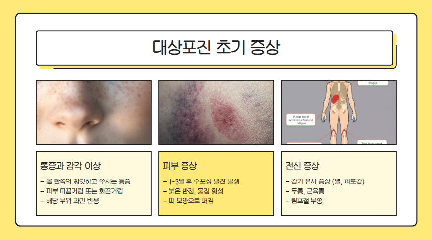 대상포진 치료법 총정리|초기증상·치료약·회복기간까지 한눈에!