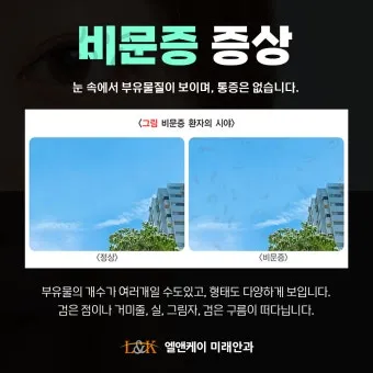 시야에 검은점 시야에 까만점이 보일때 원인과 대처법_6