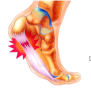 족저근막염