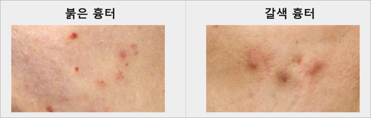 여드름 흉터 없애는법