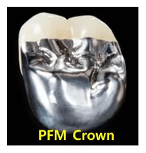 임플란트 보철재 비교 총정리 (Gold PFM Zirconia )