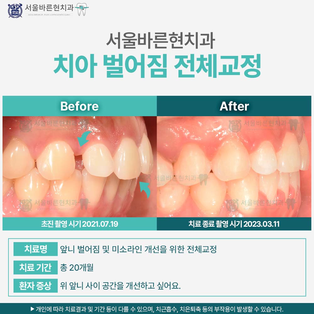 부산치아교정