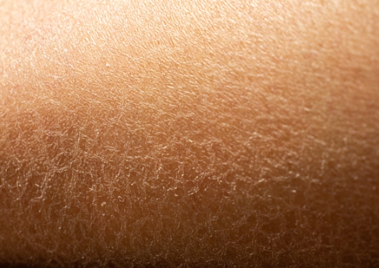 피부건조증이 심해서 각질이 일어나는 피부