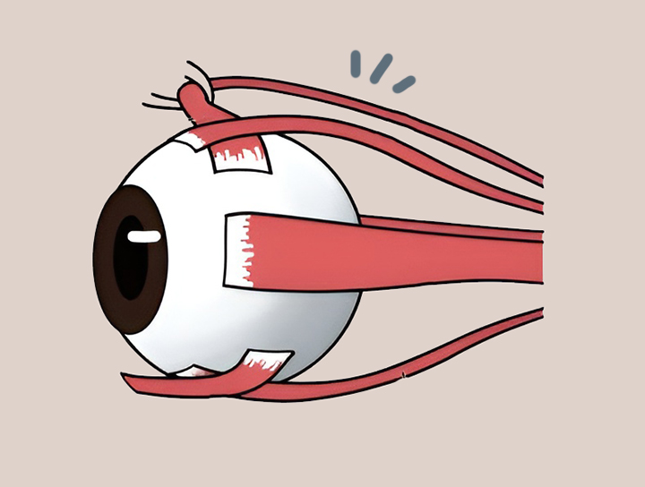 안구-근육에-문제가-생긴-모습