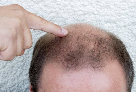 피나스테리드(Finasteride)를 이용한 탈모 치료
