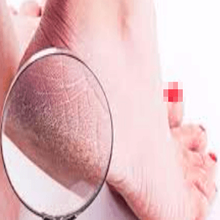 발 각질이 심한 여성