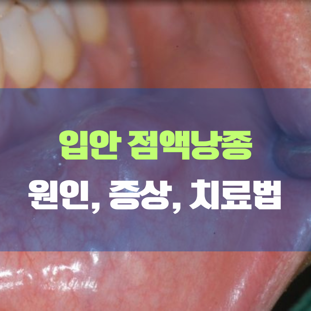 입안 점액낭종의 모든 것: 원인, 증상, 치료법, 그리고 예방하기