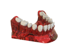 수면 임플란트 비용 과정