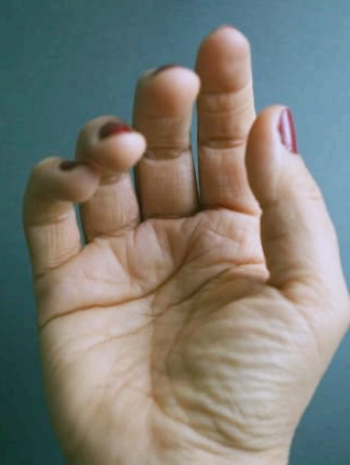 손가락 관절염 증상과 치료법