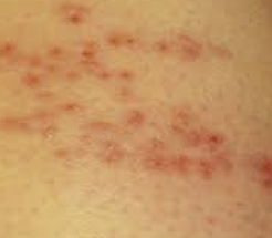 대상포진 증상 및 예방