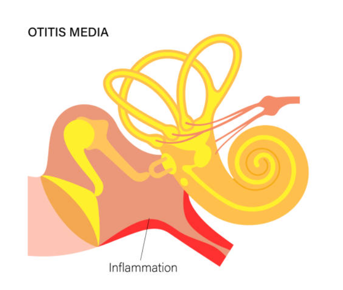 이석증과 관련된 사진1
