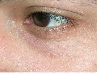 비립종 생기는 이유 비립종 없애는 방법 피부 관리법_15