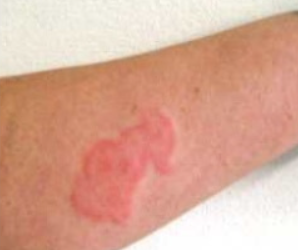 빈대-물린-자국