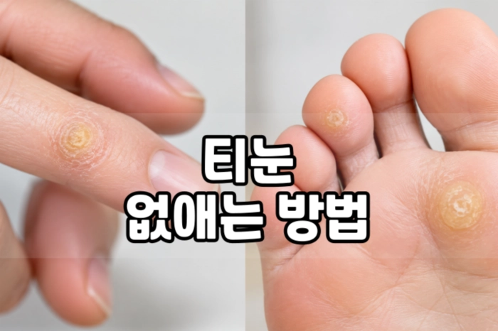 티눈 없애는 방법