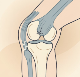 무릎 안쪽 통증 원인