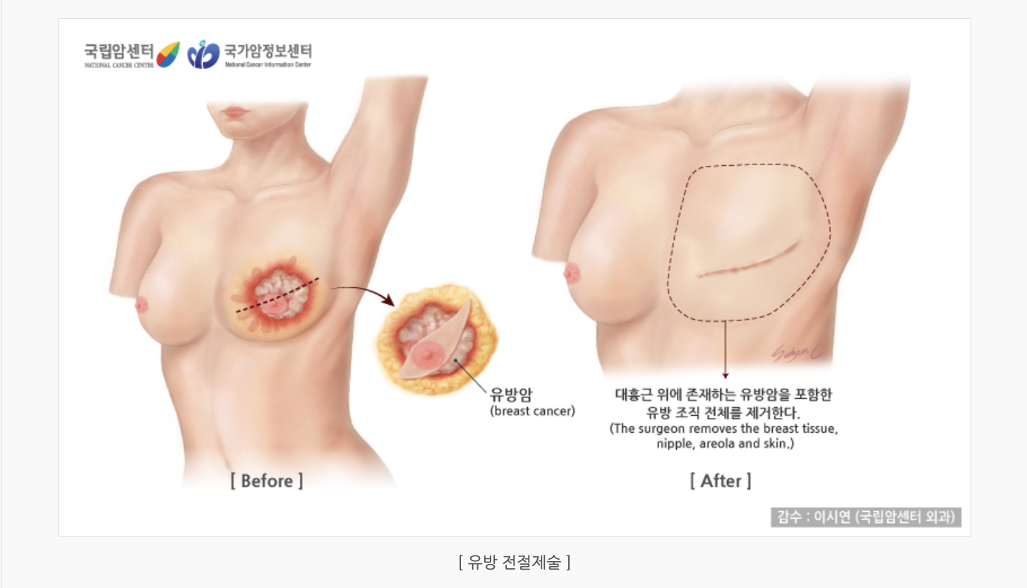 유방 전절제술