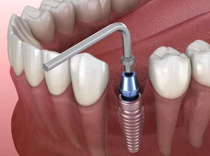 임플란트 시술과정 