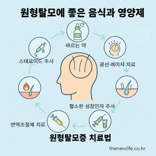 원형탈모증 치료법 인포그래픽 – 스테로이드 주사, 바르는 약(도포제), 광선·레이저 치료, 혈소판 성장인자 주사(PRP), 면역조절제 치료 등 병원 치료법을 순환 구조로 표현한 이미지