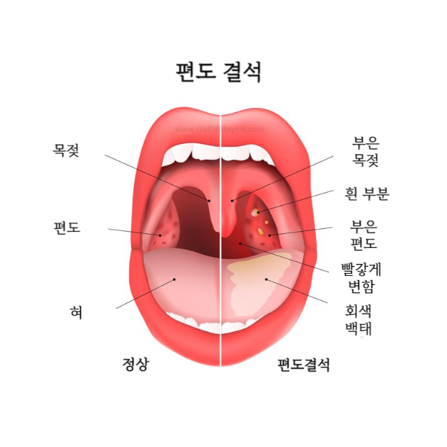 편도염