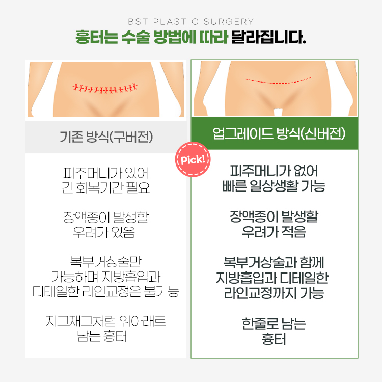 업그레이드 복부거상수술 방식
1. 피주머니가 없어 빠른 일상생활가능
2. 장액종이 발생할 우려가 적음
3. 복부거상술과 함께 지방흡입과 디테일한 라인교정까지 가능
4. 한줄로 남는 흉터