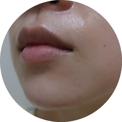 bbl 레이저 후기