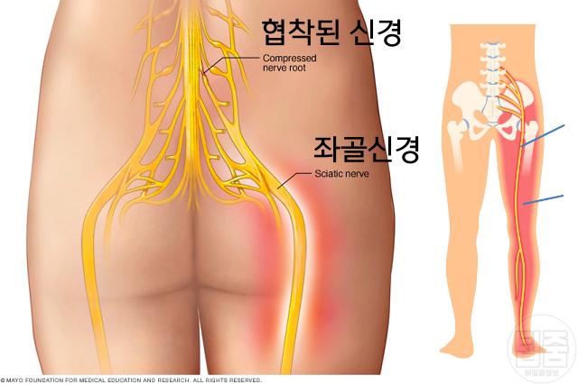 무릎 뒤 통증 원인 좌골신경통