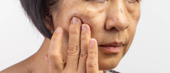 기미와 점, 주근깨는 무엇이 다를까