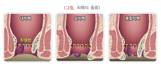 치핵 원인, 증상, 치료방법