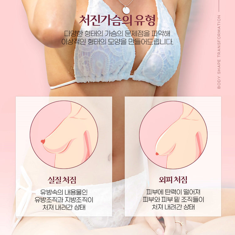 처진가슴의 종류
실질처짐: 유방속의 내용물인 유방조직과 지방조직이 처져 내려간 상태
외피처짐: 피부에 탄력이 떨어져 피부와 피부 밑 조직들이 처져 내려간 상태