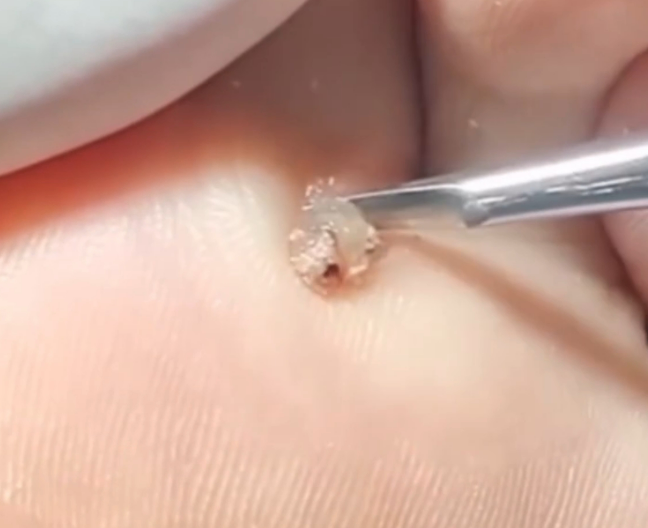 약국 티눈약으로 뿌리까지 제거하려면, 어떻게 해야할까?