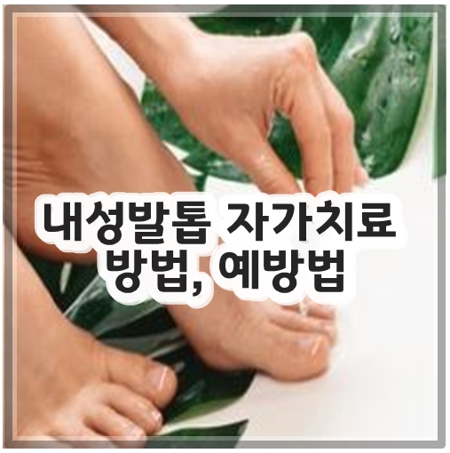 내성발톱 자가치료 방법, 예방법